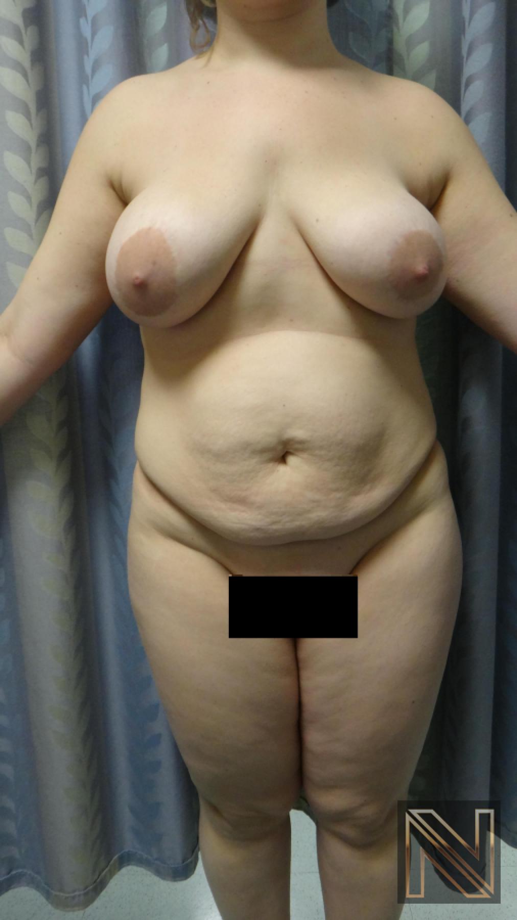 Abdominoplasty: Patient 24 - Before 1
