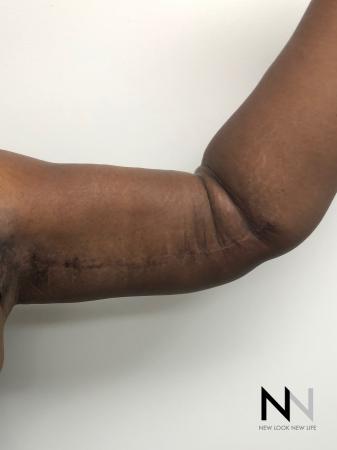 Brachioplasty: Patient 6 - After Image 4