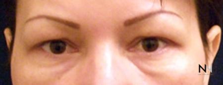 Blepharoplasty: Patient 4 - Before Image 1