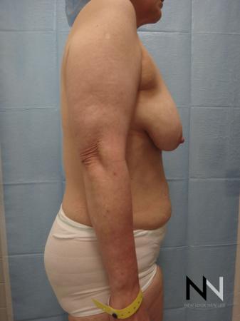 Breast Lift: Patient 3 - Before and After Image 5