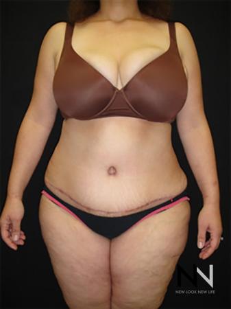 Abdominoplasty: Patient 19 - After 1