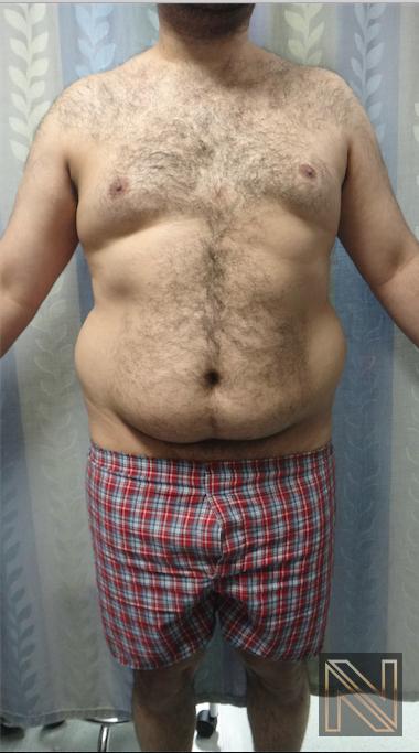 Liposuction: Patient 16 - Before 1