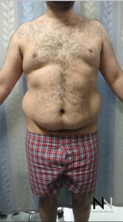 Liposuction: Patient 16 - Before Image 1
