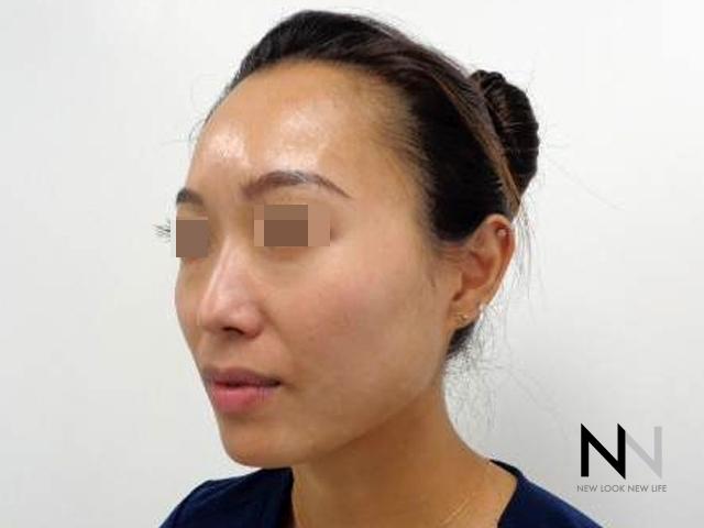 Laser Skin Resurfacing - Face: Patient 5 - After  