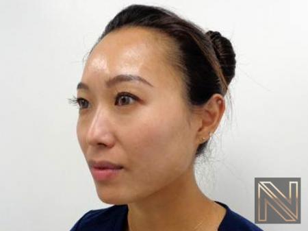 Laser Skin Resurfacing - Face: Patient 5 - After  