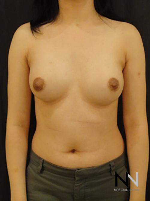 Breast Augmentation: Patient 4 - After  