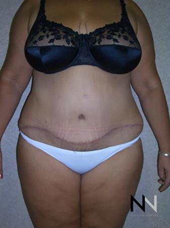 Abdominoplasty: Patient 4 - After Image 1
