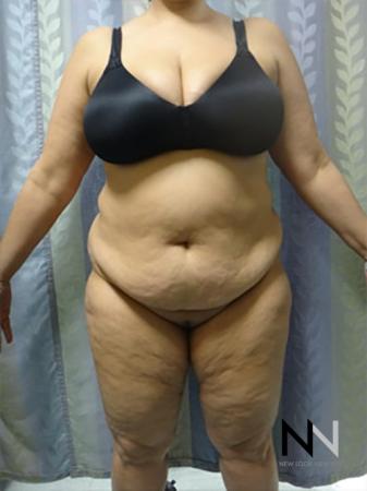 Abdominoplasty: Patient 14 - Before Image 1