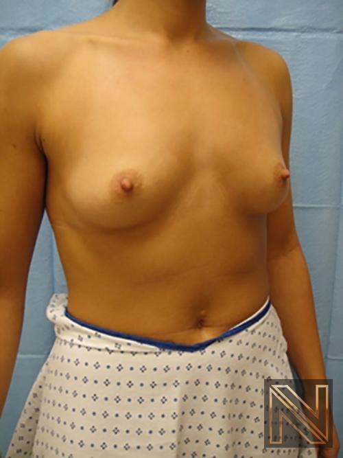 Breast Augmentation: Patient 11 - Before 3