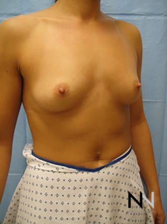 Breast Augmentation: Patient 11 - Before Image 3