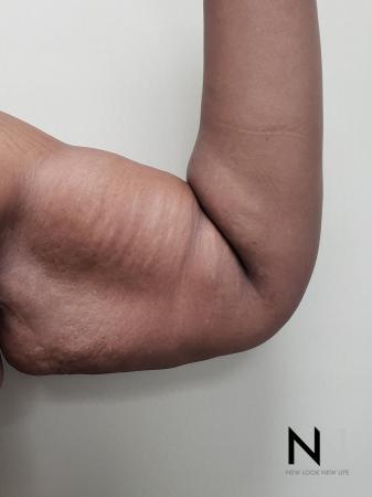 Brachioplasty: Patient 6 - Before and After Image 4