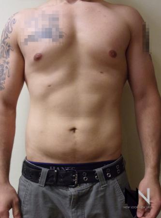 Liposuction: Patient 14 - After Image 1