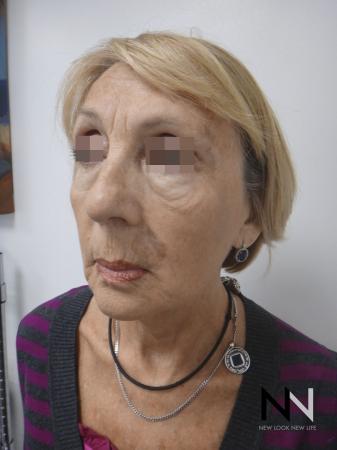 Ultherapy®: Patient 2 - After Image 4