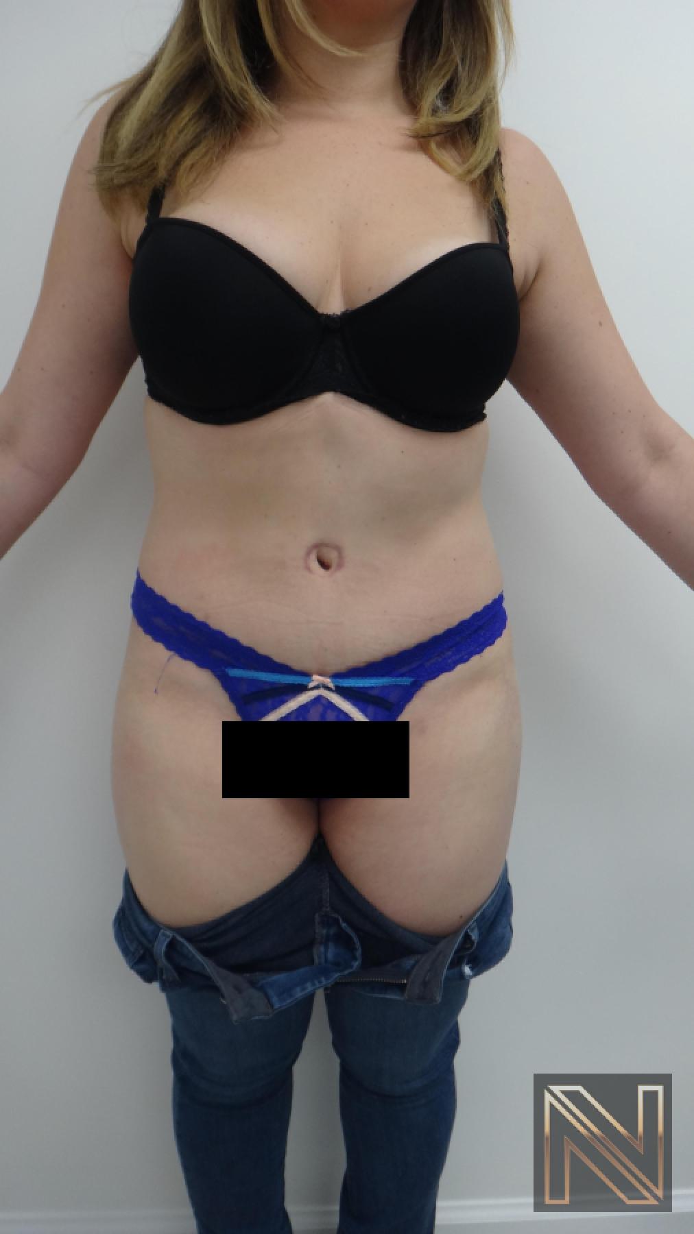 Abdominoplasty: Patient 24 - After 1