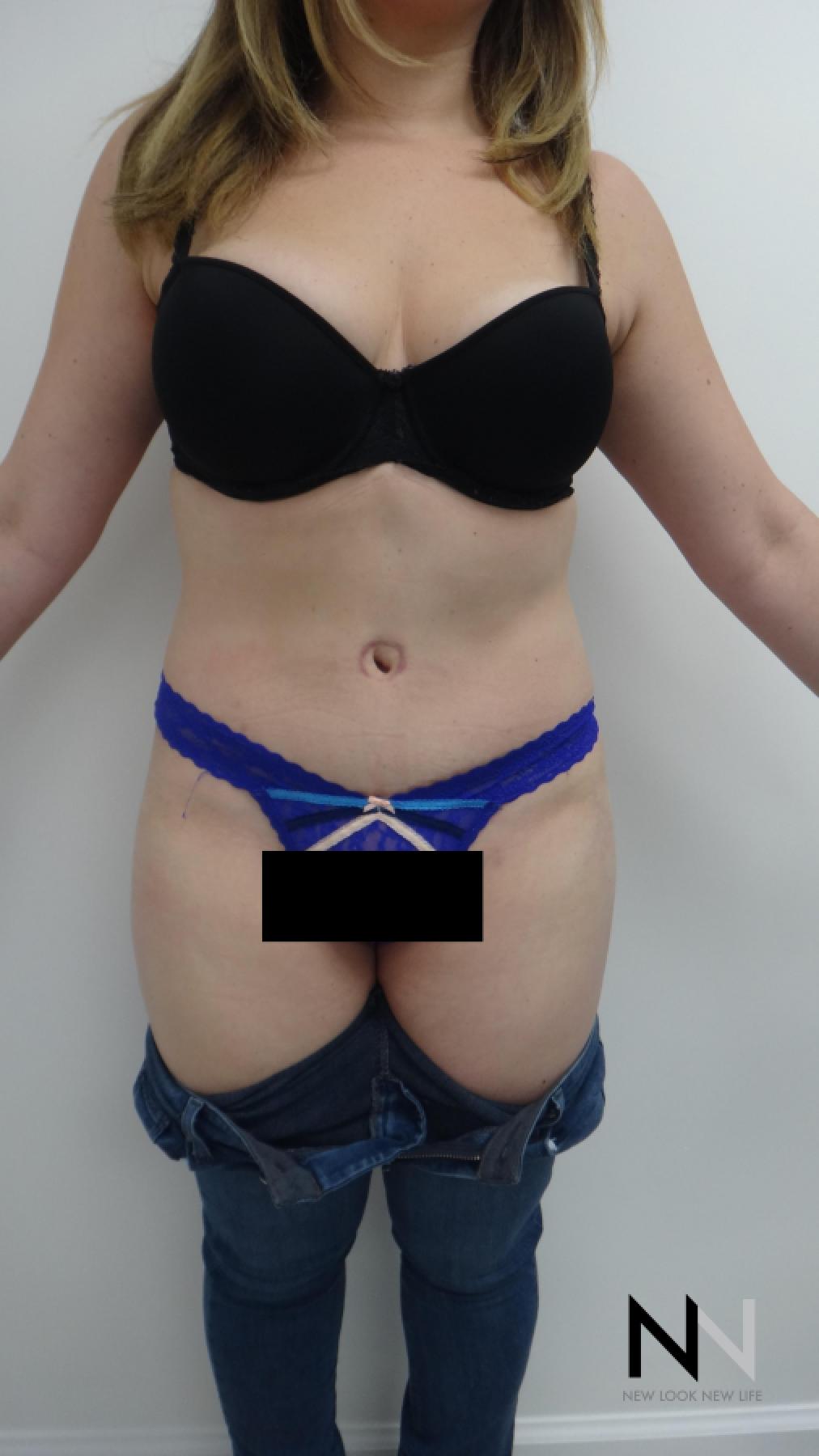 Abdominoplasty: Patient 24 - After 1