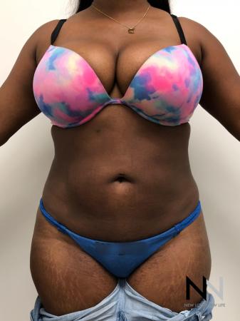 Liposuction: Patient 3 - After Image 1