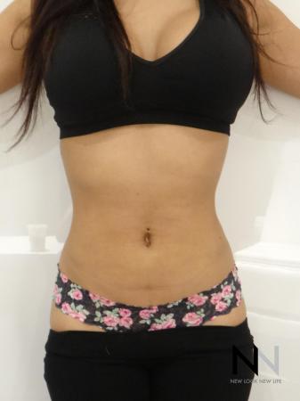 Liposuction: Patient 9 - After Image 1