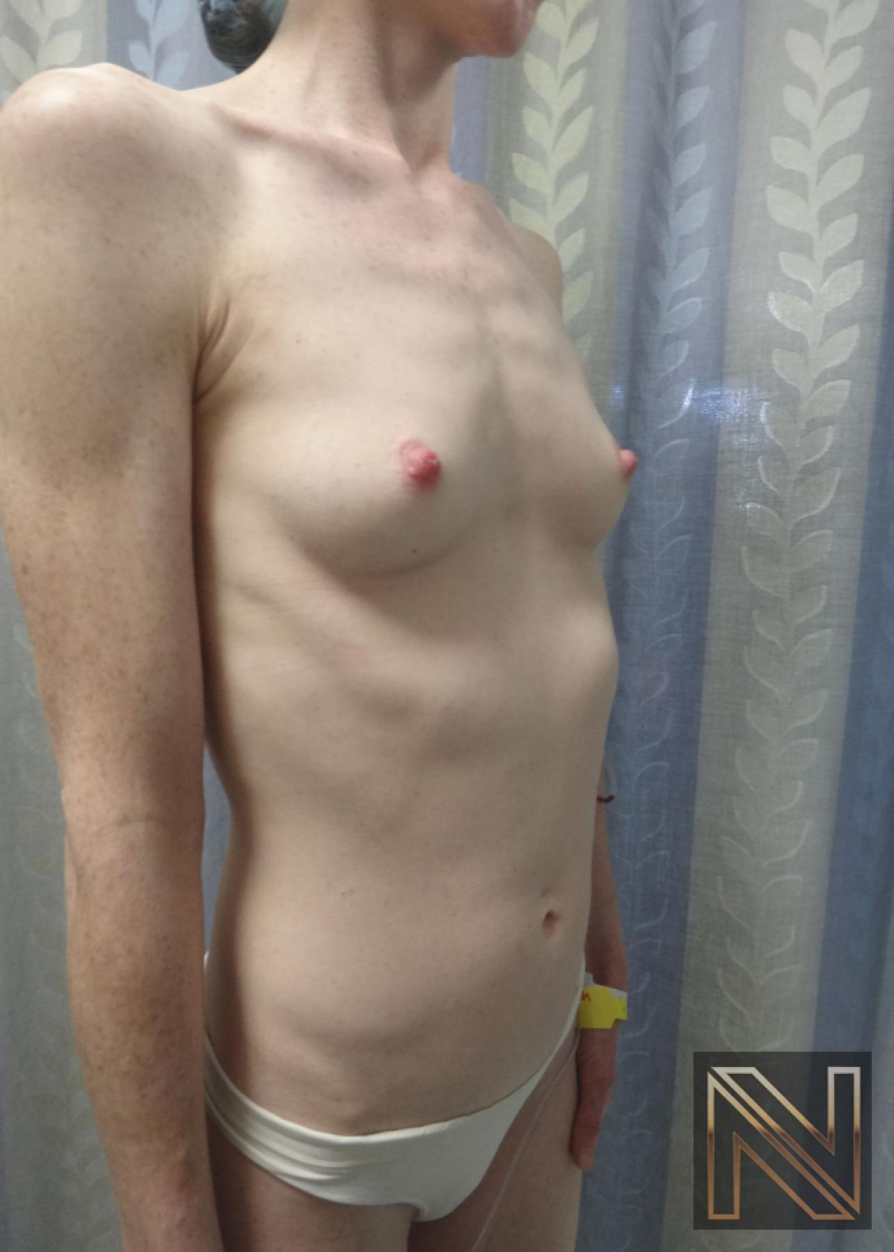 Breast Augmentation: Patient 17 - Before 3