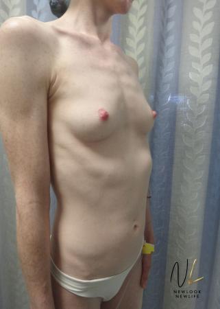 Breast Augmentation: Patient 17 - Before Image 3
