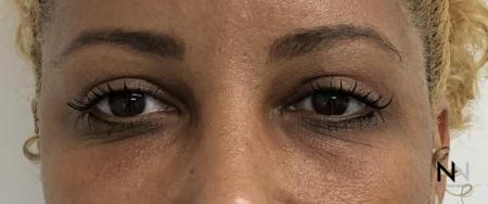 Blepharoplasty: Patient 1 - After Image 1