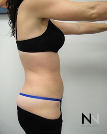 Liposuction: Patient 8 - After Image 3