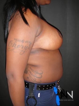 Breast Reduction: Patient 6 - After Image 5