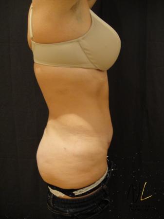 Mini Tummy Tuck: Patient 6 - After Image 2