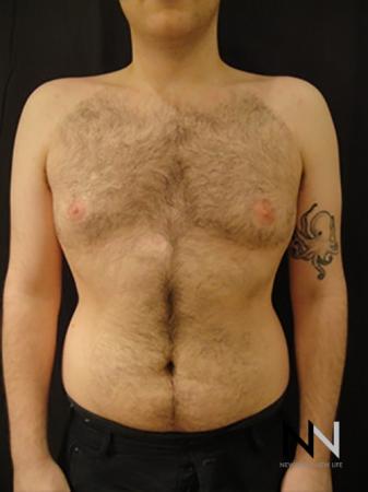 Gynecomastia: Patient 5 - After Image 1