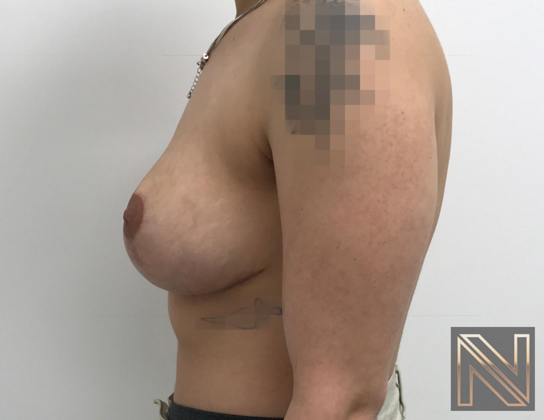 Breast Lift: Patient 17 - After 4