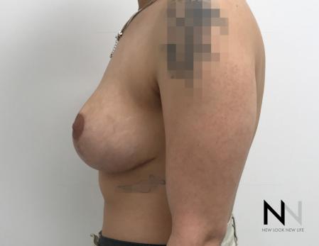 Breast Lift: Patient 17 - After Image 4