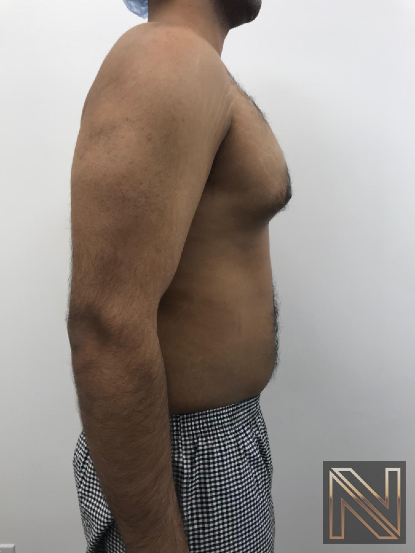 Gynecomastia: Patient 7 - Before and After 5