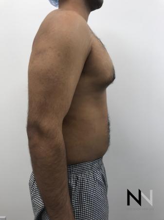Gynecomastia: Patient 7 - Before and After Image 5