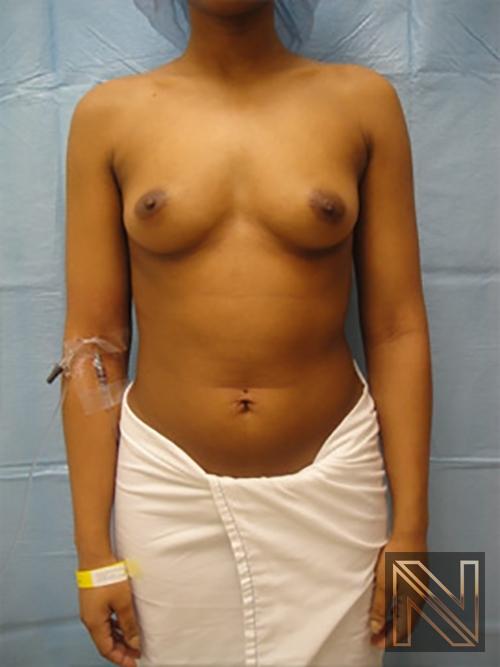 Breast Augmentation: Patient 14 - Before 1