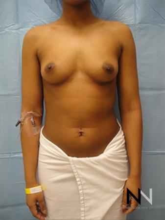 Breast Augmentation: Patient 14 - Before Image 1