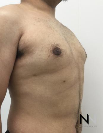Gynecomastia: Patient 10 - After Image 4