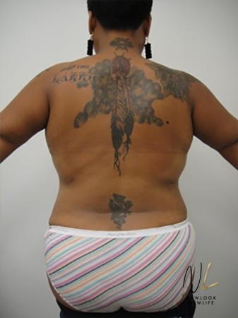 Liposuction: Patient 19 - After Image 1