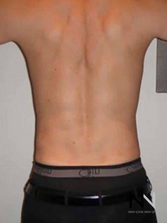 Liposuction: Patient 20 - After Image 1