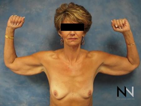 Brachioplasty: Patient 1 - Before and After Image 2