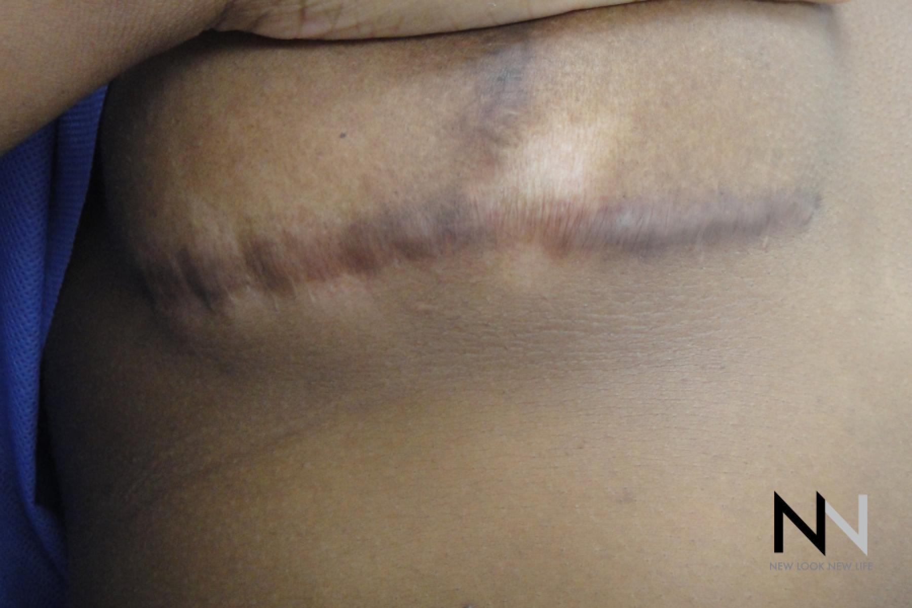 Fractional Resurfacing: Patient 9 - Before 