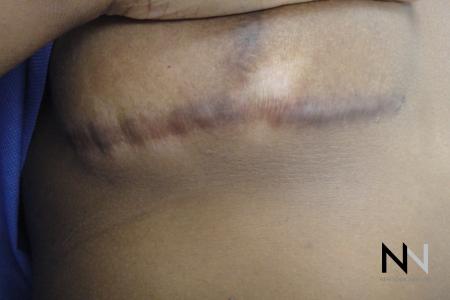 Fractional Resurfacing: Patient 9 - Before Image 1