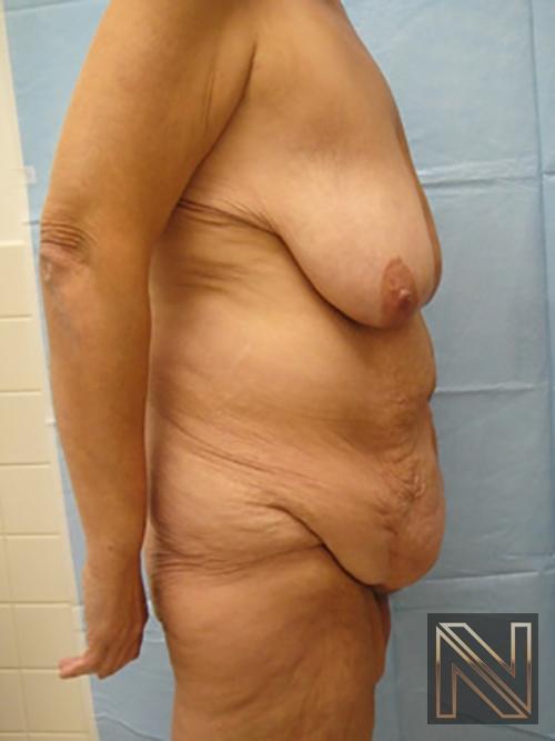 Abdominoplasty: Patient 3 - Before and After 3