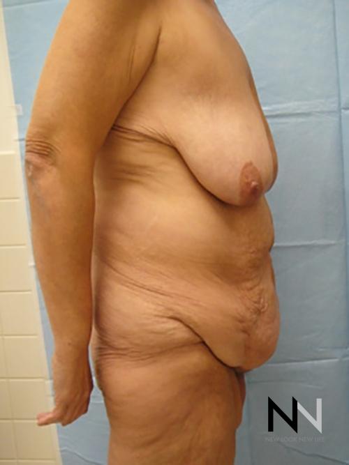 Abdominoplasty: Patient 3 - Before and After 3