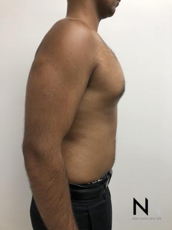 Gynecomastia: Patient 7 - After Image 5