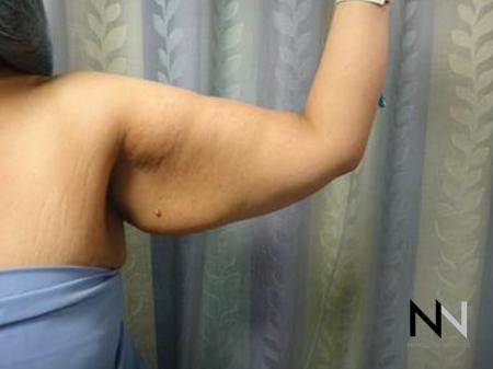 Brachioplasty: Patient 3 - Before Image 1