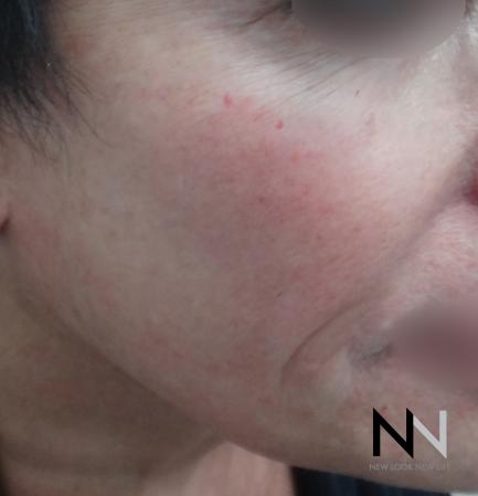 Halo™: Patient 4 - Before and After Image 2