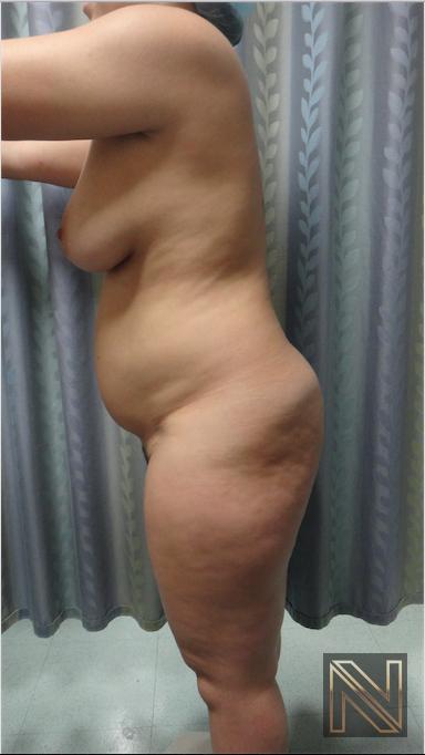 Liposuction: Patient 15 - Before 3