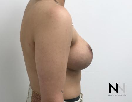 Breast Lift: Patient 17 - After Image 5