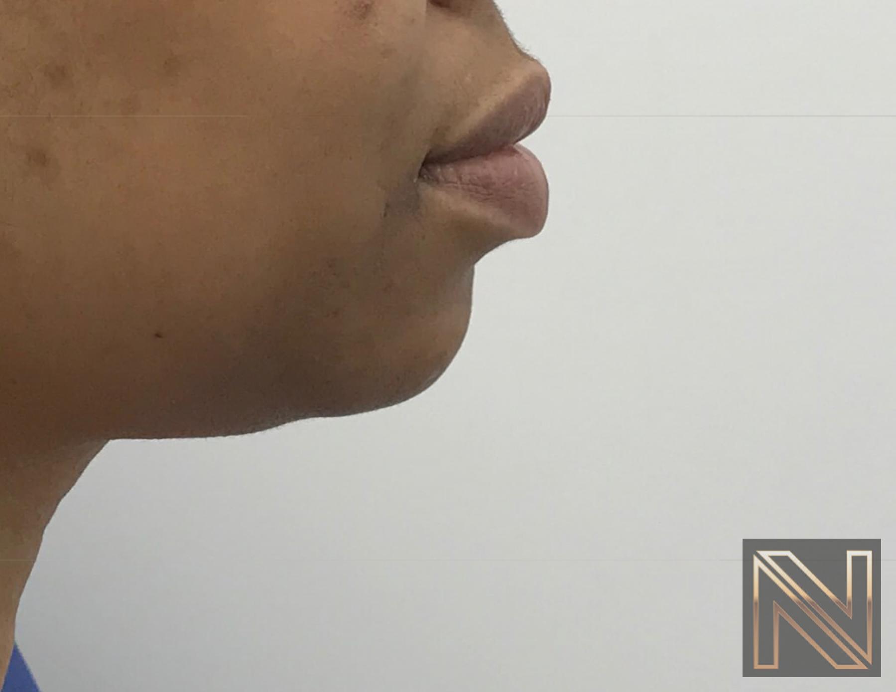Chin Augmentation: Patient 3 - Before 4
