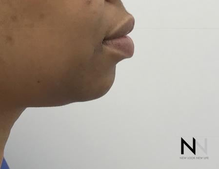 Chin Augmentation: Patient 3 - Before Image 4