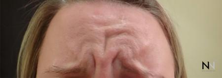 Dysport® : Patient 4 - Before Image 1